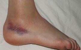 Ankle Sprain