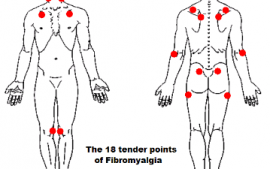 Fibromyalgia