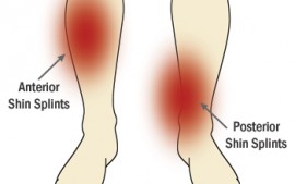 “Shin Splints”