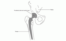 Total Hip Replacement