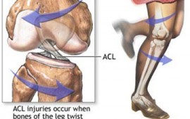 Anterior Cruciate Ligament (ACL) Rupture