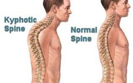 Kyphosis