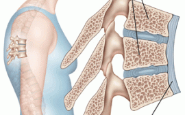 Scheuermanns Disease