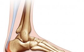 Severs Disease
