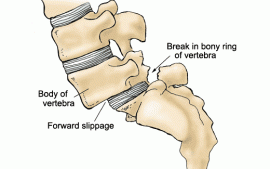 Spondylolisthesis in Dancers