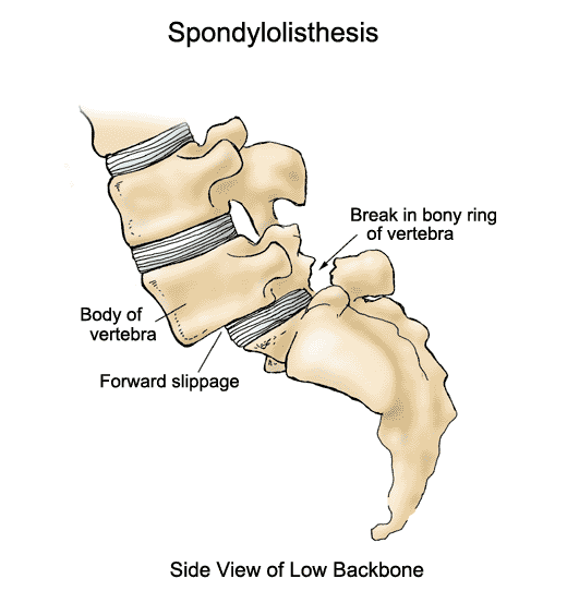 Spinal Bracing: A Treatment Option for Spondylolisthesis